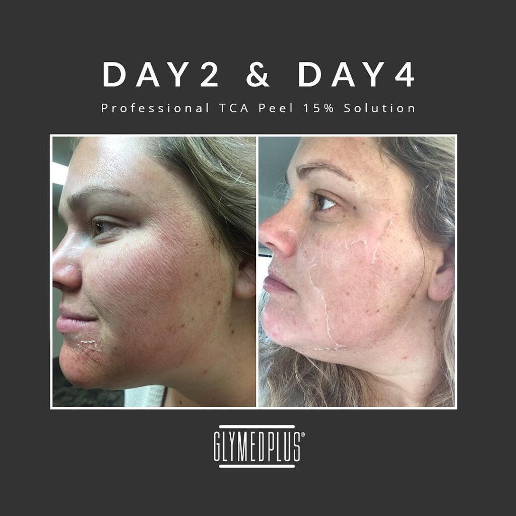 before after glymed