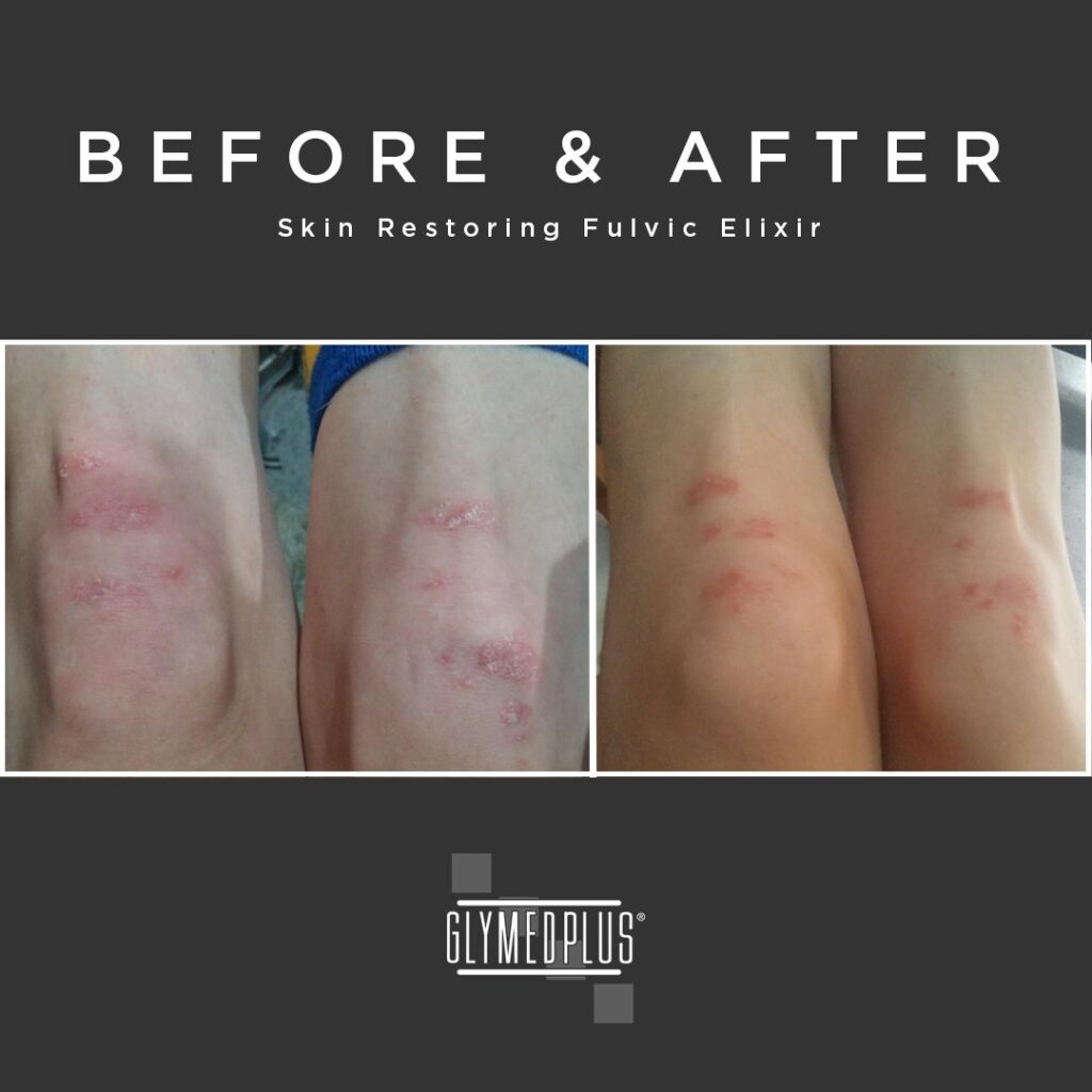 before after glymed